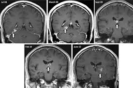 Image result for Brain Lesion