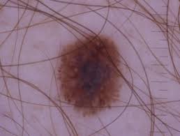 Check spelling or type a new query. Perpendicular White Lines Dermoscopy Dermnet Nz