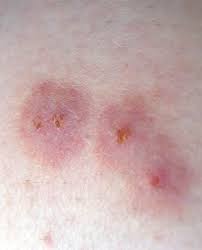 11 Common Bug Bite Pictures How To Id Insect Bites And Stings Joel carillet / getty images owner. 11 common bug bite pictures how to id