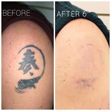 Answered by change of art laser tattoo removal. Twitter à®‡à®² Laserwise Clinic Cardiff Another Happy Client Today After Their 6th Laser Treatment For Tattoo Removal One Or Two More Sessions Should Do The Trick 02921322424 Info Laserwiseclinic Com