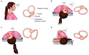 Image result for Canalith Repositioning Procedure