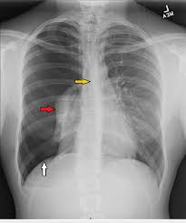 Image result for Pneumothorax
