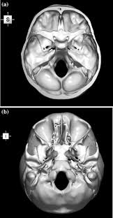 Anatomical structures of the skull include: A 3d Stereotactic Atlas Of The Adult Human Skull Base Brain Informatics Full Text
