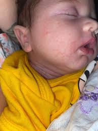 Alergia ao leite? | BabyCenter