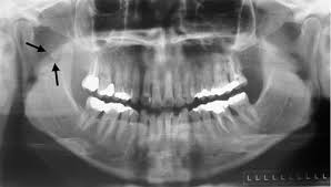 Image result for Tonsillolith