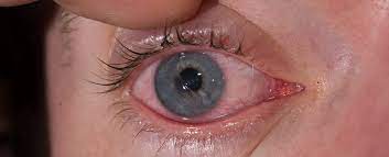 Symptoms Of A Scratched Cornea - Eye Center Of Texas