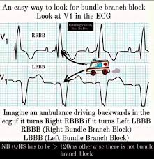 Image result for Left Bundle Branch Block