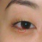 Un Parazit Periculos Cauzează Papiloame Pe Corp Totuși El Poate Fi Distrus Eye Floaters Treatment Eye Floaters Causes What Causes Eye Floaters