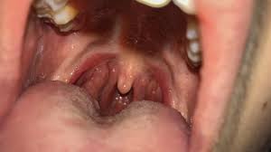 Image result for Canker sores symptoms roof of the mouth