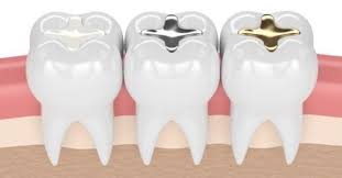 If you have managed to chip your tooth and need a quick emergency dental care option, temptooth can provide a temporary tooth fill for you. Tooth Cavity Filling By Silver And Composite Material Dentist In Santa Rosa