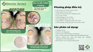 Chi phí điều trị mụn có đắt không?