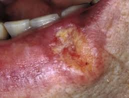 Experts recognize four types of squamous cell carcinomas of the lung Squamous Cell Carcinoma Of The Lip Images Dermnet Nz