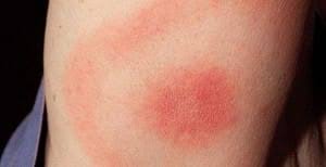 Z wyjątkiem kilku przypadków, takich jak gorączka zachodniego nilu i zapalenie mózgu st. Lek Na Borelioze Test Antybiotyk Przewlekla Leki Na Borelioze Bez Recepty Cena Chroniczna Antybiotykoterapia Jaki Jest Najlepszy Lek Na Borelioza Brm Med Warszawa