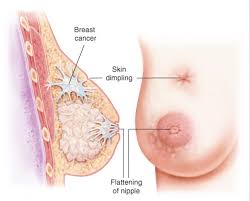 The skin may or may not change color. Normal Breast Vs Gynecomastia