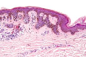 Dysplastic Nevus Wikipedia