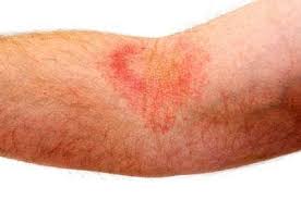 The seems to only appear after i have been exposed to the sun, either by being outside or through the window of my car. Sweat Rash Information Expresschemist Co Uk Buy Online