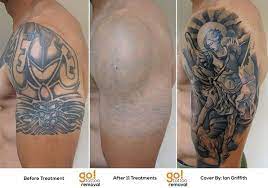 Due to the lockdown we had to close our shop, and i am currently not booking or tattooing clients until further notice. Last Weekend We Shared The Progress Achieved With This Client S Half Sleeve Removal This Is What Is Possible When Laser Tattoo Removal Tattoo Removal Tattoos