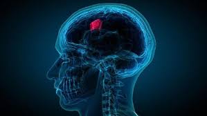 Migrain tanda awal kerusakan otak? Waspada Tumor Otak Ketahui Cara Penanganan Yang Efektif