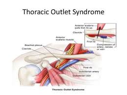 The Greedy Pinstripes Out With Thoracic Brachial Subclavian Artery