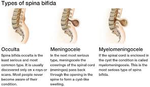 Spina Bifida Scoliosis