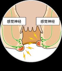 Patients often don't realize they have an internal hemorrhoid unless there is the presence of blood. Incarcerated Hemorrhoids And External Thrombosed Hemorrhoids Official Brand Site