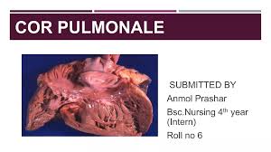 Image result for Cor Pulmonale