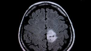 Kopfschmerz Kein Typisches Symptom Bei Hirntumoren Witzenhausen