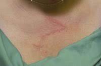 Image result for Linear Dermatitis