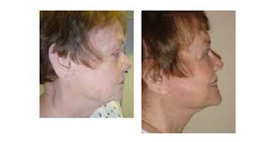 Facelift in Jacksonville. You deserve to Look Your Best!