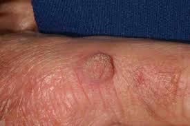 Of types of skin cancer. Chapter 8 Skin Cancer 909