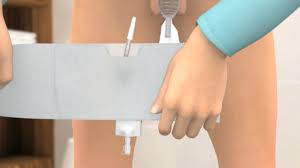 Die selbsthaftenden urinalkondome überzeugen durch seine einfache anwendung und ausgewogene haftung. Anwendung Kondom Urinale Und Beinbeutel Coloplast