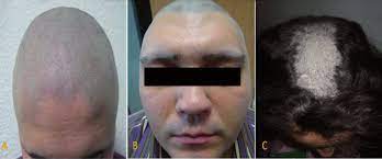 Hair loss following trauma can typically be treated with advanced hair restoration techniques by our highly experienced doctors at true & dorin medical hair replacement following trauma. Case 1 And 2 Mild And Circumscribed Erythema On The Scalp Signs Of Download Scientific Diagram