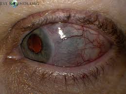 Image result for lesion sclera