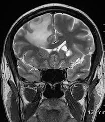 Image result for Neurosyphilis