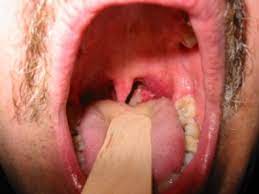 Throat cancers and cancers that affect the mouth, are together all called oropharyngeal cancers. Throat Cancer A Typical Patient S Story Texan Ent Specialists