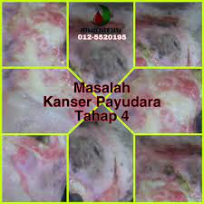Namun, meski tanpa alat canggih, kanker payudara tetap dapat dideteksi dari awal dengan. Masalah Kes Terapi Alhijamah Bekam Di Pulau Pinang Facebook