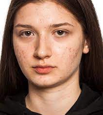 Cover only the pigmented area, as the cream will also lighten the unaffected area. How To Get Rid Of Scars Naturally 10 Best Home Remedies To Try