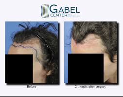 As the follicles leave the telogen stage, they'll begin to produce hair and grow at a rate typical for average hair growth. Watch A Patient S Real Time Growth After 3439 Grafts Gabel Center