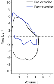 Image result for Exercise Spirometry