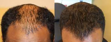 Despite this situation, the hair transplantation to treat the worsing hair loss is much less common. African Americans How Ethnicity Plays A Role In Hair Transplants Modena Hair Institute
