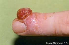 Many people who have granuloma annulare don't need treatment. Pyogenic Granuloma