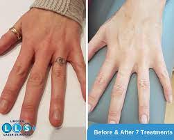 Vivian chin at koru wellness aesthetics can help you with laser tattoo removal! Laser Tattoo Removal Lincoln Laser Skin Care