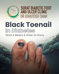 Image result for toe black diabetes