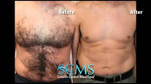 Get the new buff pro bundle. Ictendavraniyor Before After Chest Wax