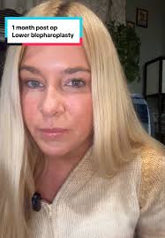 One Month Recovery from Lower Blepharoplasty