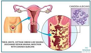 Image result for Vaginitis