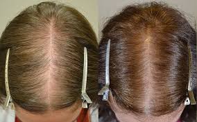 Spironolactone (the active drug in aldactone) has been used to treat a specific type of hair loss called androgenic alopecia. Spironolactone Hair Restoration Of The South New Orleans La