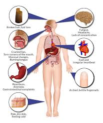 Initially, iron deficiency anemia can be so mild that it goes unnoticed. Iron Deficiency Anaemia Cfch Centre For Clinical Haematology