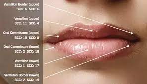 lip cancer begins on either the upper or, most commonly, lower lips. Is It Possible To Get Skin Cancer From Picking On Your Lips Quora