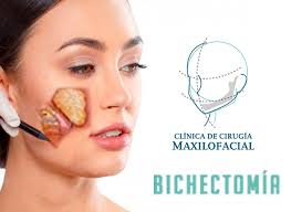 Veja fotos antes depois e preço bichectomia no rj. Blog La Bichectomia